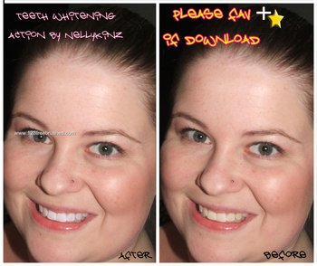 Adjustable Teeth Whitening