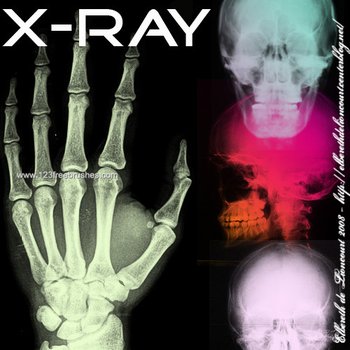 X-Ray
